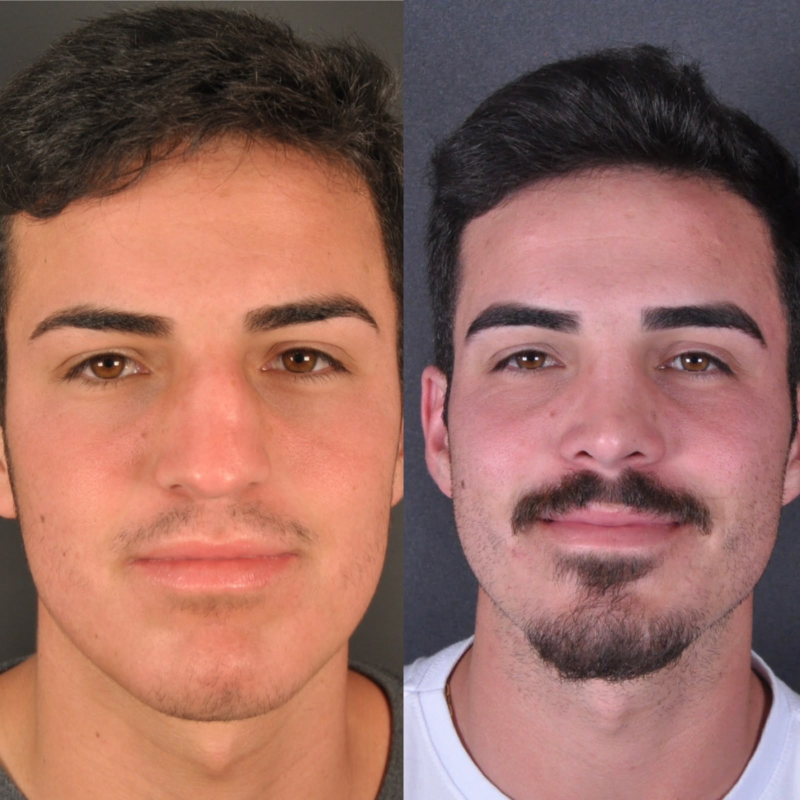 Antes e depois — frontal masculino