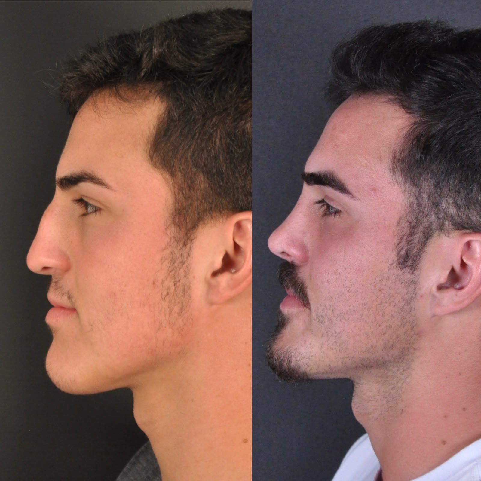 Antes e depois — perfil masculino
