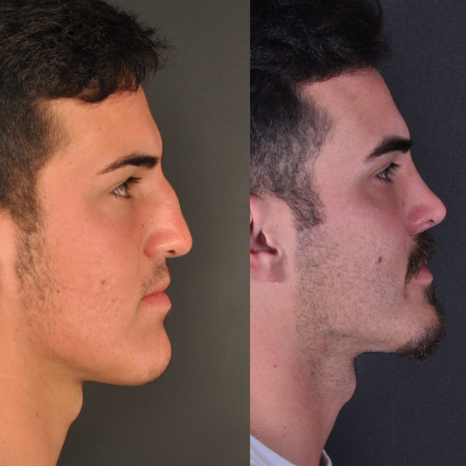 Antes e depois — basal masculino