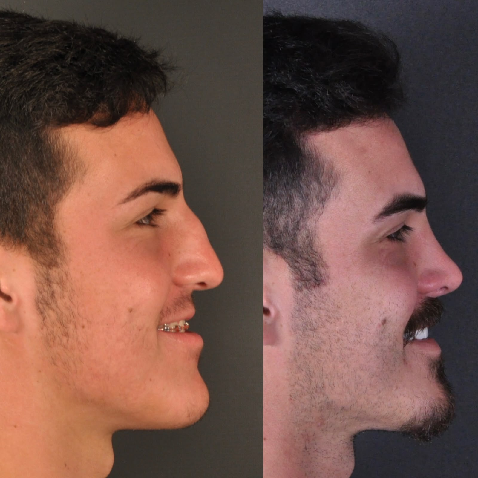 Antes e depois — oblíquo masculino