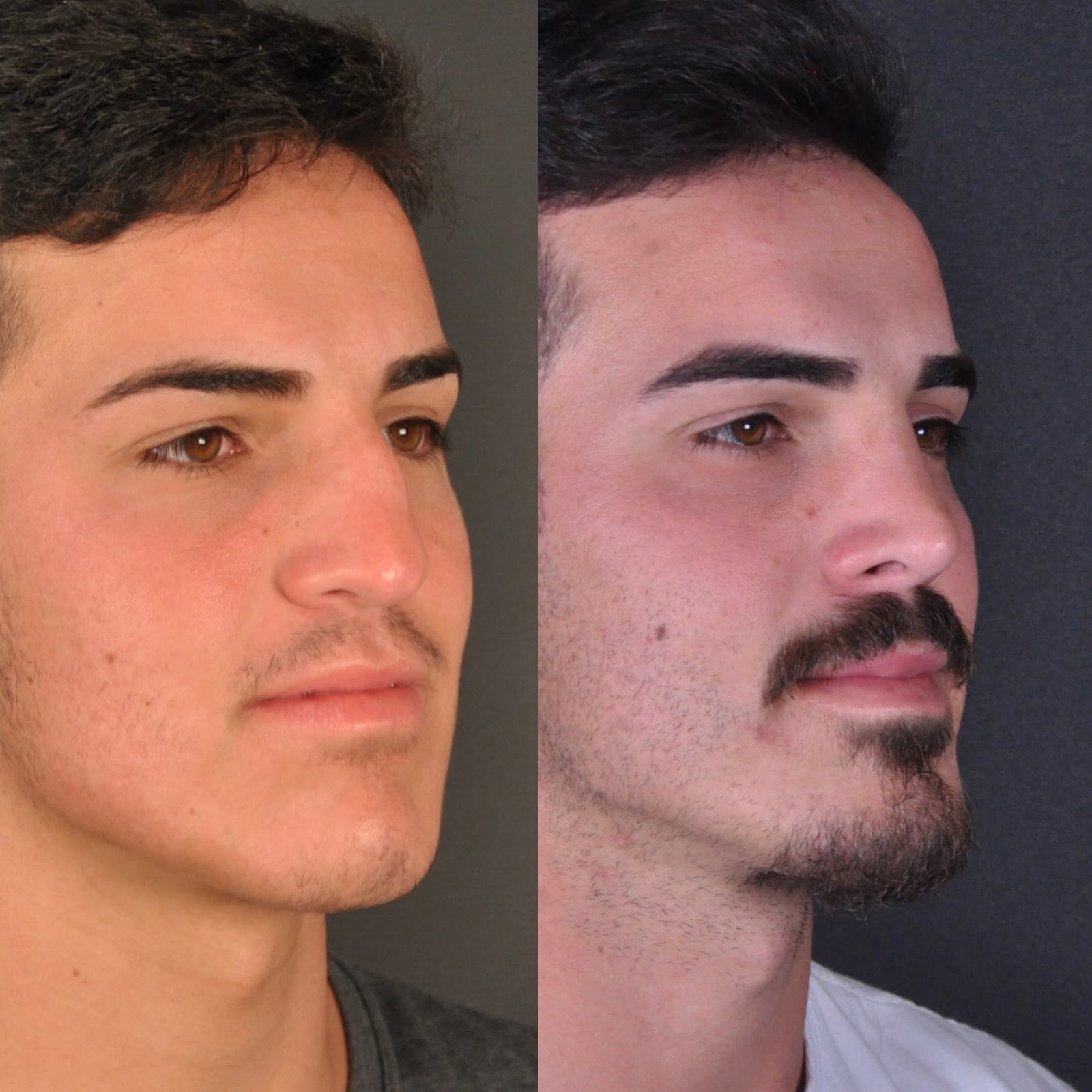 Antes e depois — diagonal masculino