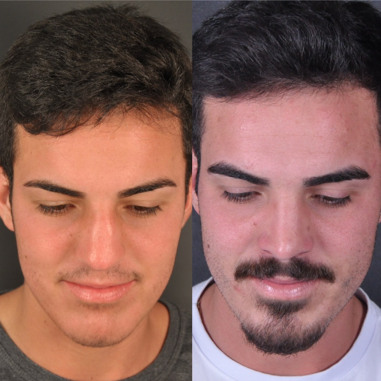 Antes e depois — perfil oblíquo masculino