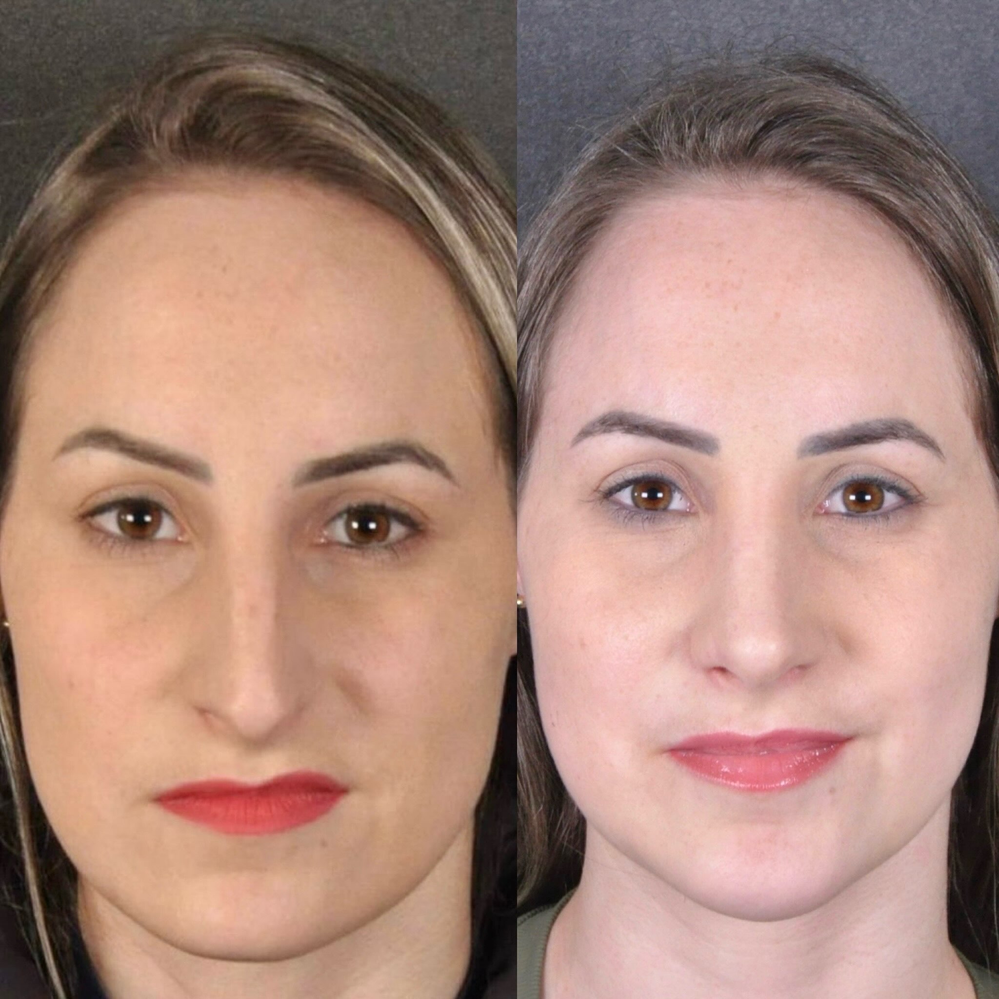 Antes e depois — frontal feminino