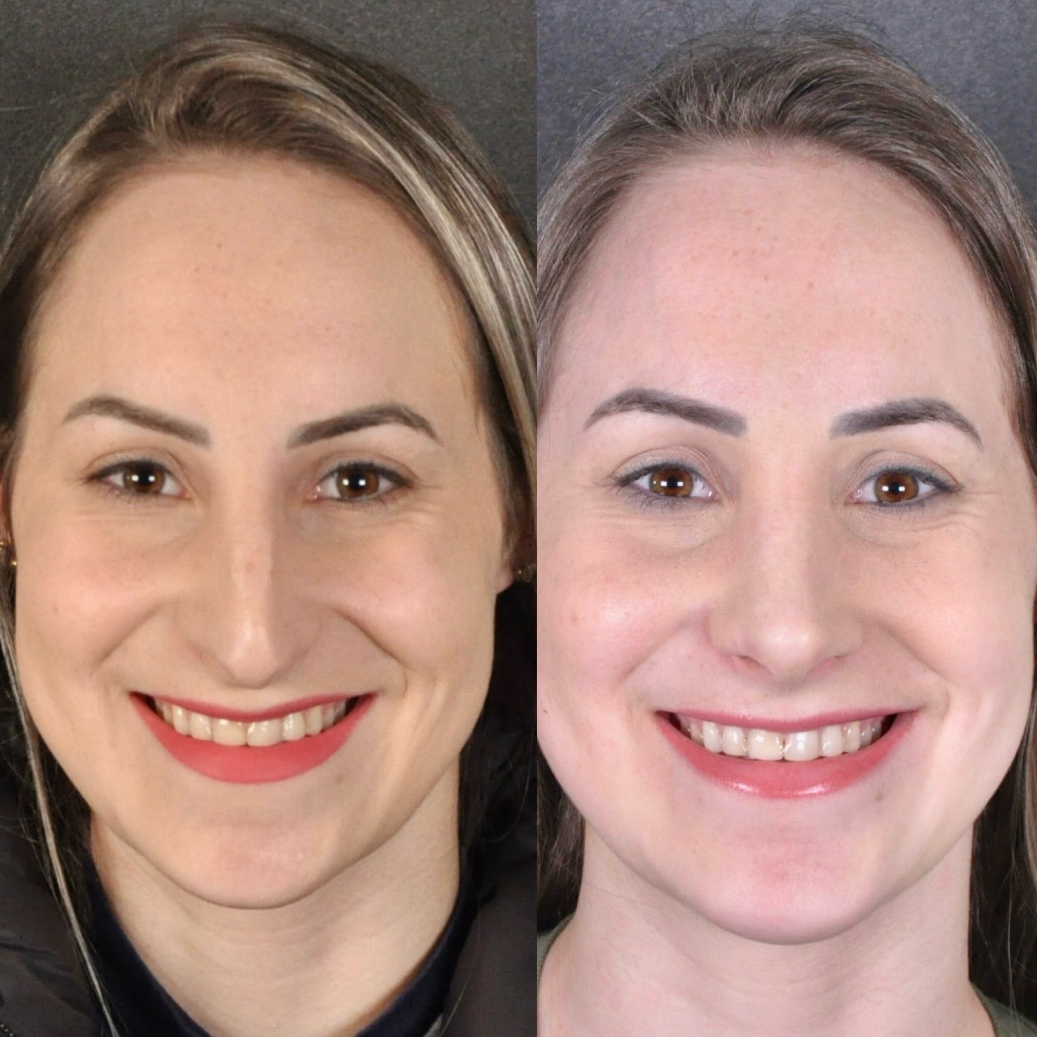 Antes e depois — frontal sorrindo feminino