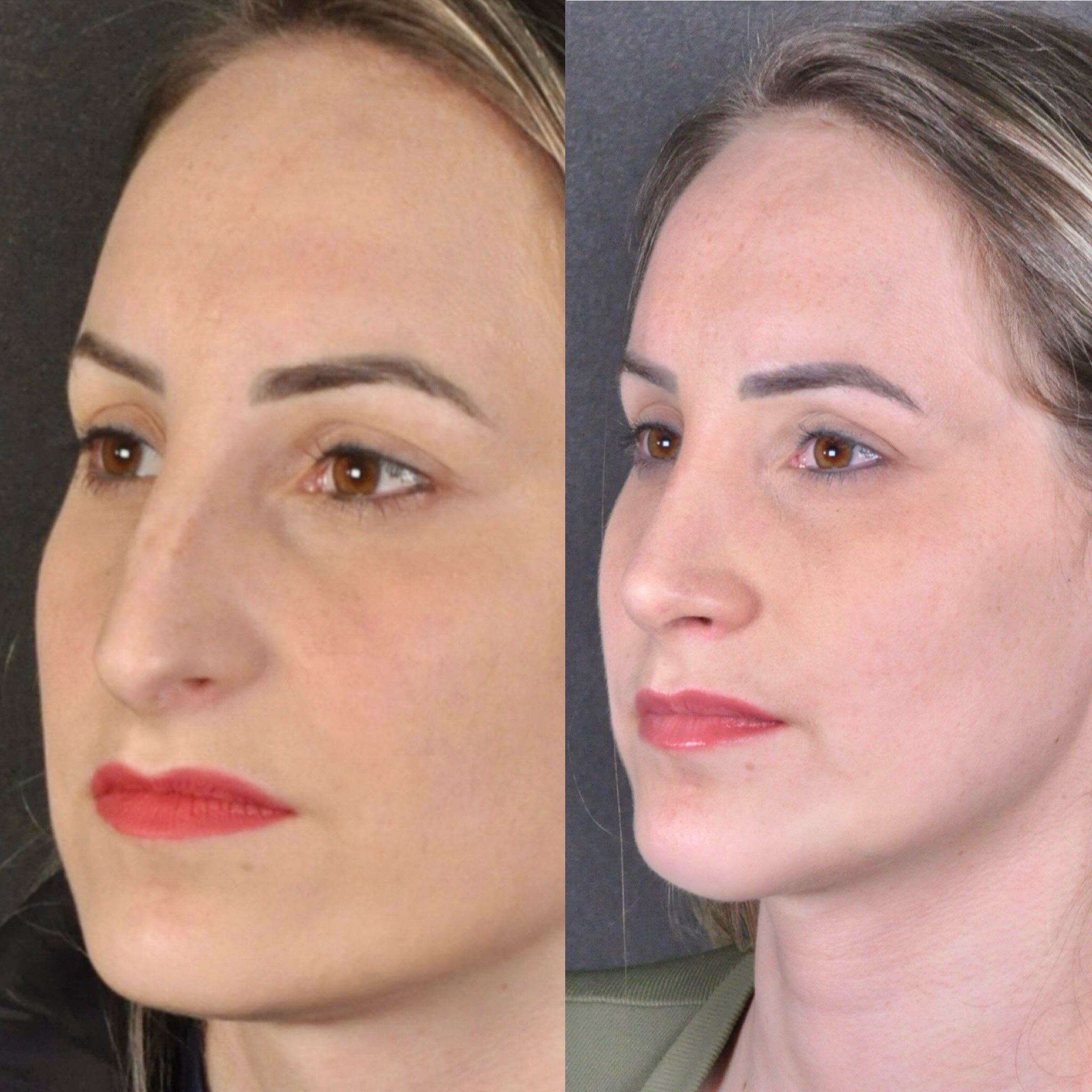 Antes e depois — oblíquo feminino