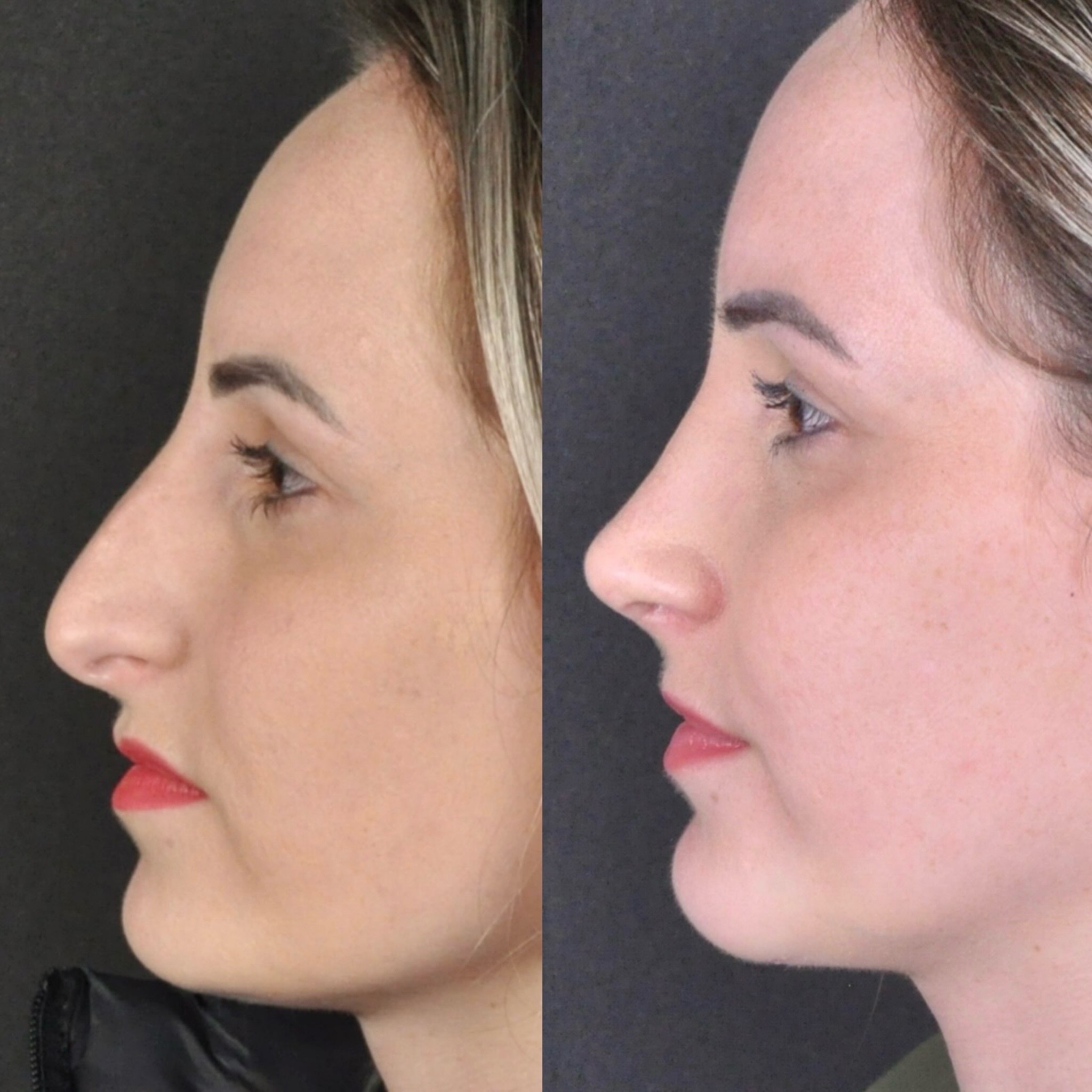 Antes e depois — oblíquo feminino 2