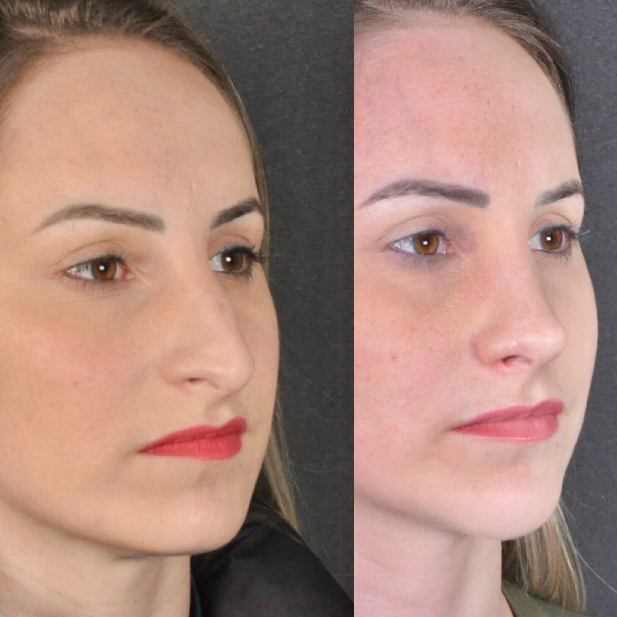 Antes e depois — diagonal feminino