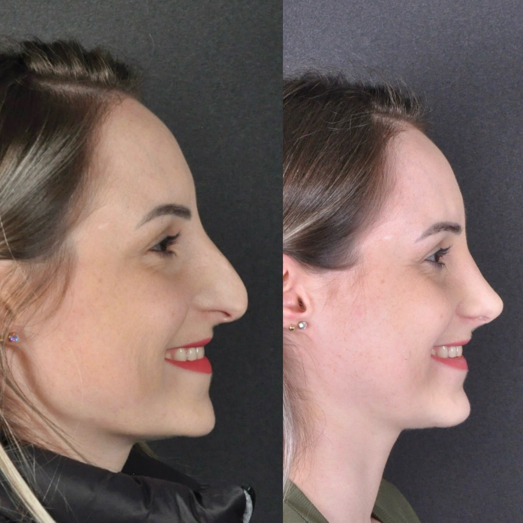 Antes e depois — perfil feminino